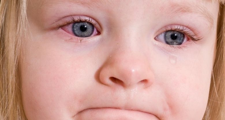 Конъюнктивит: как его лечить и что делать, когда глаза краснеют